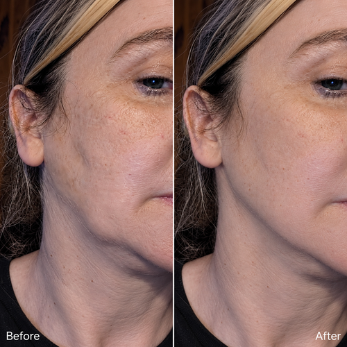 Lymphara® Lymphatic Drainage Drops